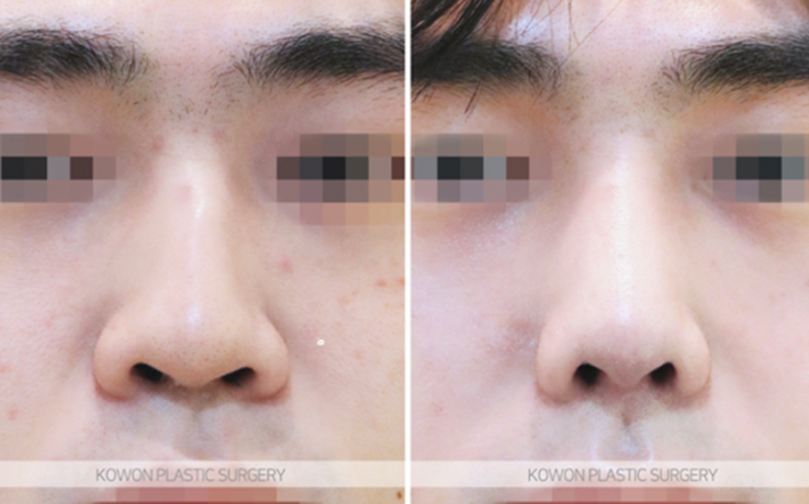 Q. The three-dimensional look that changes before and after male nose surgery: What changes are possible with male nose surgery? image 7