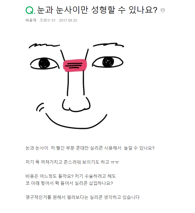 Q. 눈과 눈 사이 콧대 높일 수 있을까요?(비개방코성형으로 미간 높이기) 관련 이미지 2