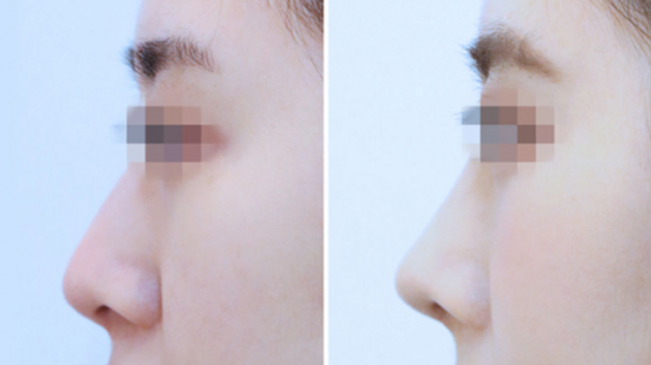 Q. 웃을때 화살코 수술 필요한데, 퍼진코수술 정보가 궁금해요 관련 이미지 5