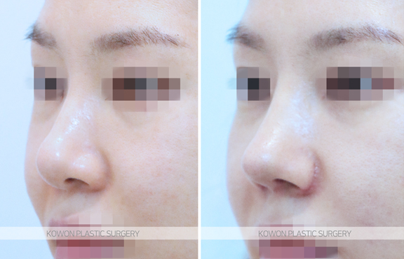 Looking at the Change Process Before and After Bulbous Nose Surgery and the Flow of Nasal Tip Structural Improvement image 6