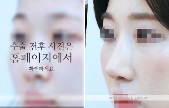 비순각교정 VS 단순 코높임 차이점과 회복에 대하여 관련 이미지 5