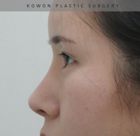 과도하게 화려한코, 귀연골에 비중격코수술로 자연스럽게 개선 됐어요! 관련 이미지 19