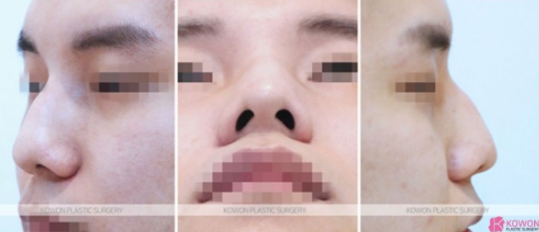 The Recovery Period After Deviated Septum Surgery and 3 Key Factors Determining Male Nose Balance image 6