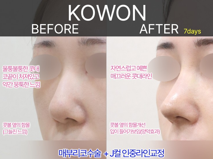 여자매부리코, 복코까지 함께 고려해야 하는 3가지 이유 관련 이미지 7