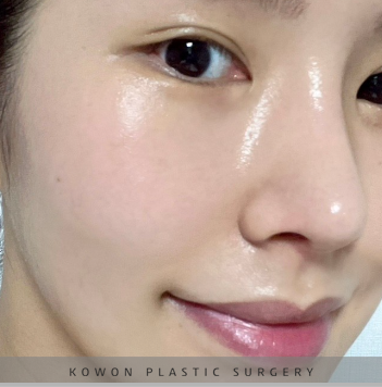 과도하게 화려한코, 귀연골에 비중격코수술로 자연스럽게 개선 됐어요! 관련 이미지 21