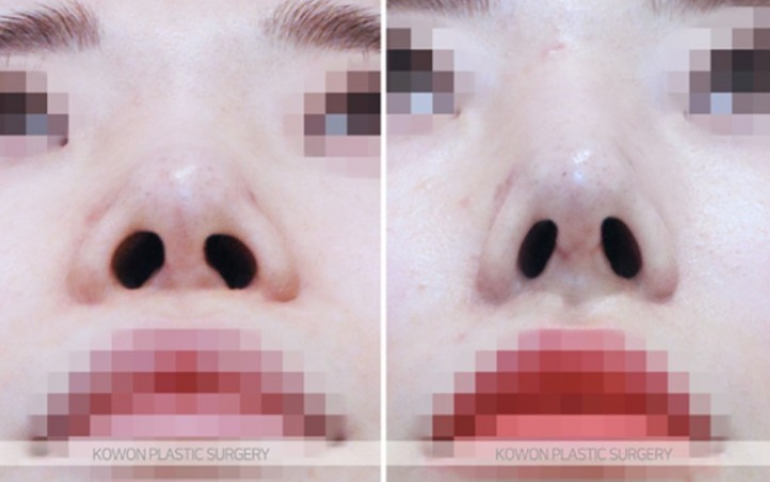 Will Autologous Rib Cartilage Nose Surgery Look Natural? A Process That Refined the Drooping Tip and Glabella Line image 7