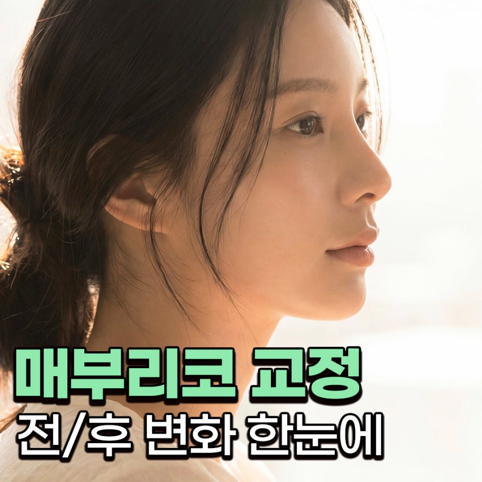 매부리코성형 전후 얼마나 차이날까? 복코와 넓은 콧볼까지 함께 고려한 변화 관련 이미지 1