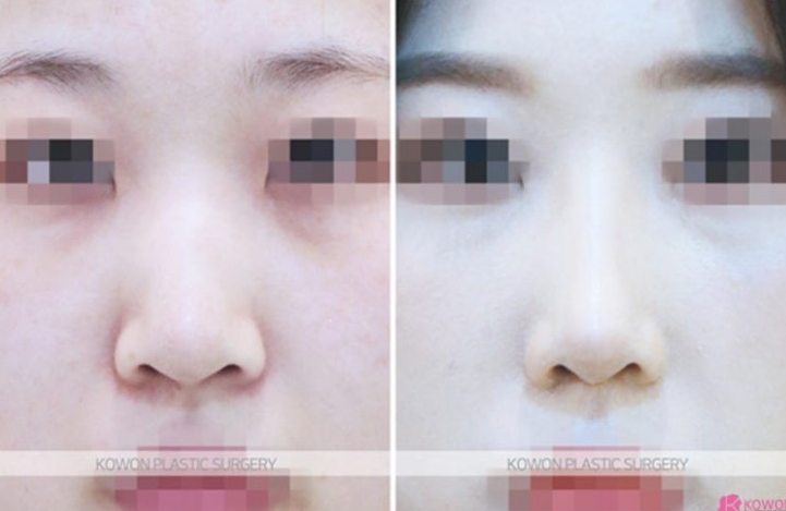 Q. 코수술전필러 래디어스필러 제거 후 수술로 버선코 만들 수 있을까요? 관련 이미지 5
