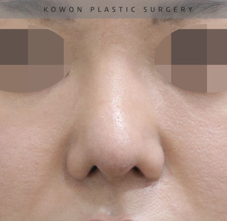 This is a review of nose surgery for a bulbous nose using donated rib cartilage at Kowon Plastic Surgery! image 15