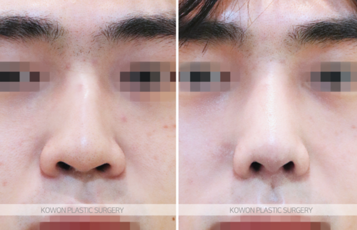 Correcting a Hump Nose and Positive Changes in the Nose Tip Line Shown in Before-and-After Male Rhinoplasty Photos image 5