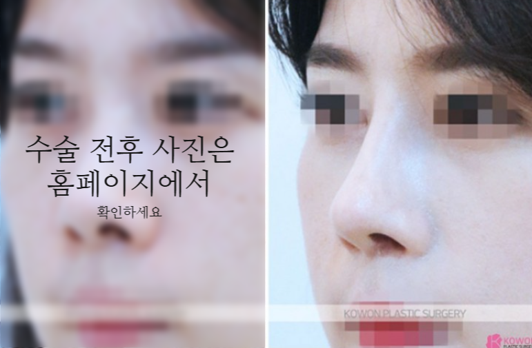 작은코성형에서 입체감 있는 코 라인을 만드는 핵심 3가지 관련 이미지 7