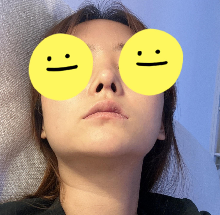 Revision Rhinoplasty Using Autologous Rib Cartilage, I Resolved My Concerns Through Surgery! image 5