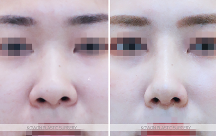 Q. Learn About Changes Before and After Alar Reduction Surgery Without Implants and Alar Reduction Surgical Methods image 9