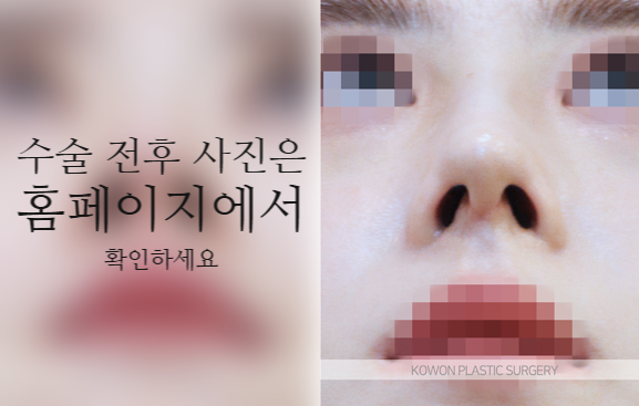코끝연골재배치 자연스러운 자려한 코를 만드는 3가지 포인트 관련 이미지 7