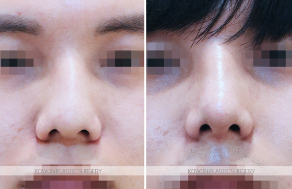Q. I bumped my nose after nose surgery. It’s been over a year since the operation—will it be okay? image 4