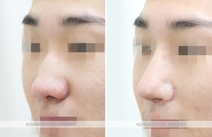 Q. After nose surgery, I had nasal congestion and blew my nose, and something foreign came out of my nose image 3