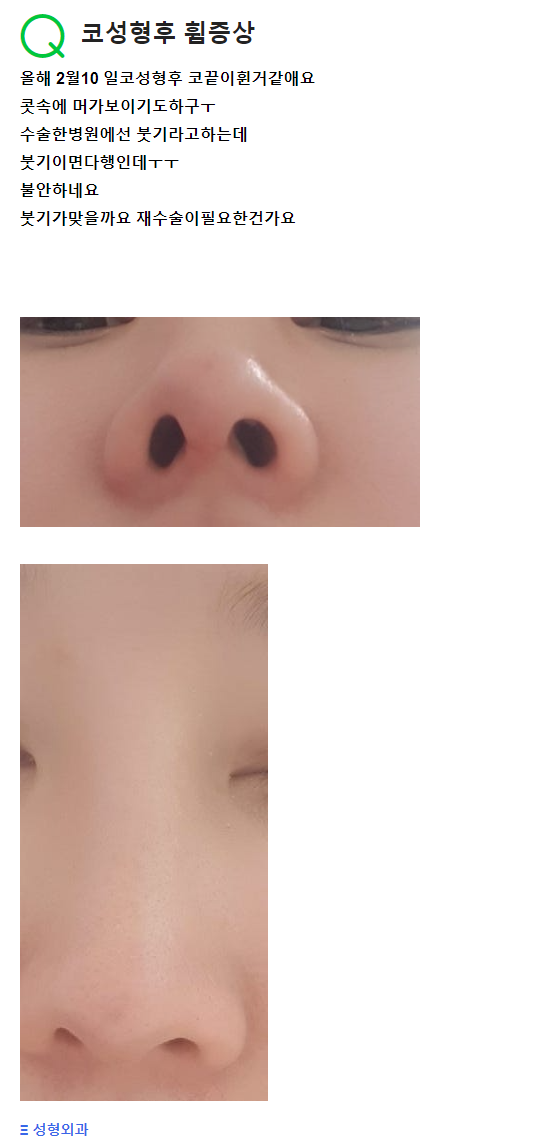 Q. 코성형 후 비중격연골 코휘어짐(휘어진코) 증상 관련 이미지 2