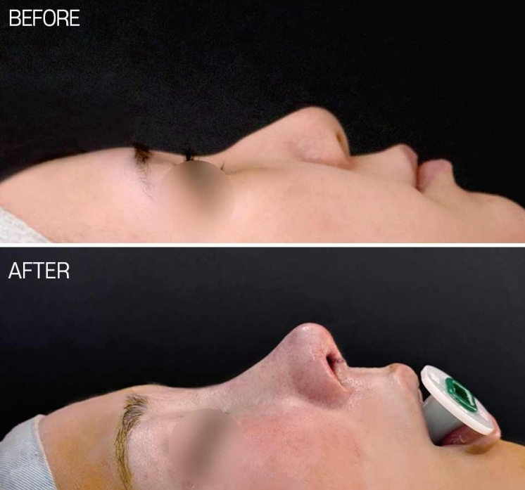 Q. My nose looks artificial because of swelling after bulbous nose surgery. Should I get revision rhinoplasty? image 6