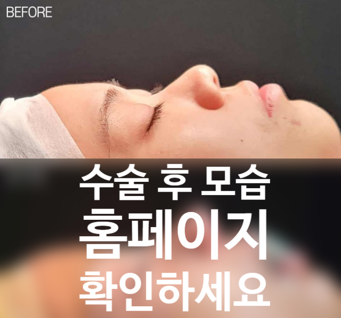 퍼진코수술 전후 입체감 비교와 코원성형외과 중안면부 개선 노하우 관련 이미지 2