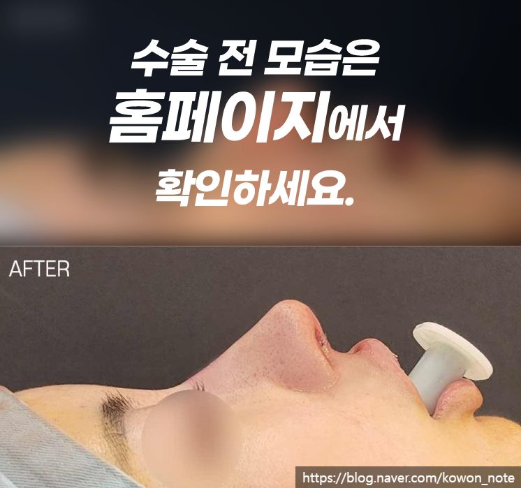 용코 교정 실제 사례로 보는 콧구멍 노출 완화와 세련된 코 라인 관련 이미지 2