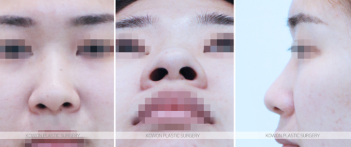 Q. Are there differences in nostril shape depending on the type of nose surgery and incision method, or not? image 3