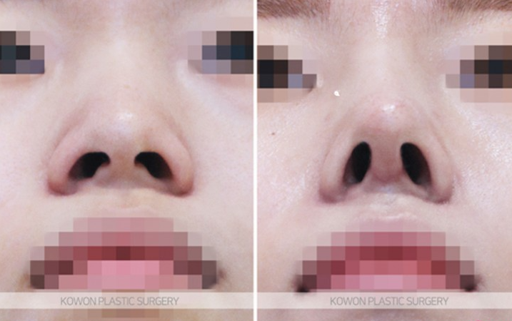 Q. How much swelling is there one month after nose surgery? Questions before rhinoplasty image 9