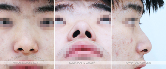 Q. 비중격만곡증 수술 경험 후 복코 관련해서 남자코성형 고민입니다. 관련 이미지 3