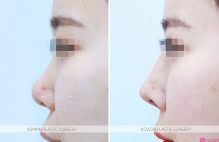 Q. I’m 고민 whether this is a side effect of cartilage nose surgery after revision rhinoplasty near Sinsa Station image 10