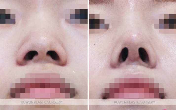 Q. 휜코재수술, 코뼈절골 통한 기능코수술 가능할까? 관련 이미지 5