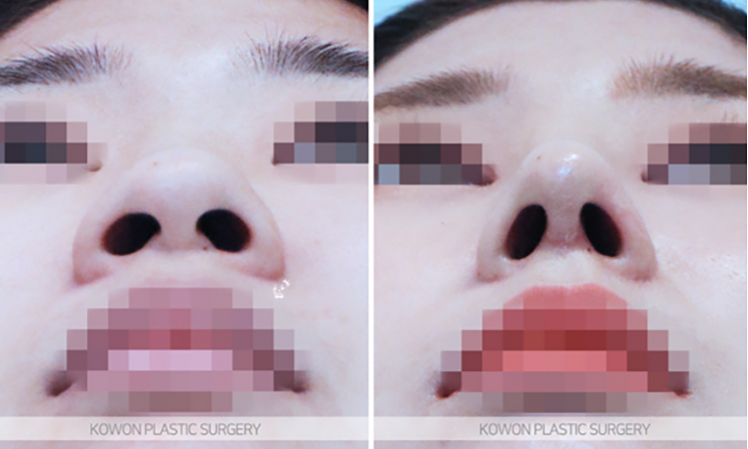 Q. I’m worried because of the difference before and after nostril reduction surgery image 6