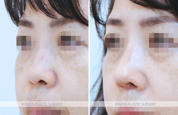 Q. It seems like swelling from low-nose surgery—would it be better to remove the silicone? image 3