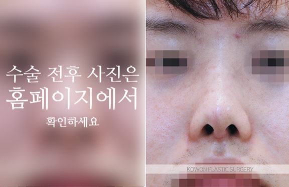 남자복코수술 매부리코와 콧볼을 함께 교정해야 자연스러운 이유 관련 이미지 8