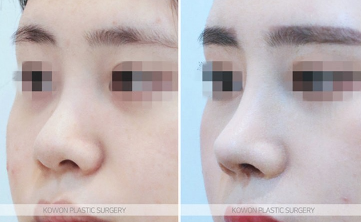Q. Can I Have a Non-Implant Nose Surgery Along with Changes Before and After Bulbous Nose Surgery? image 5