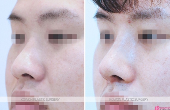 Q. After nose surgery, I had nasal congestion and blew my nose, and something foreign came out of my nose image 4