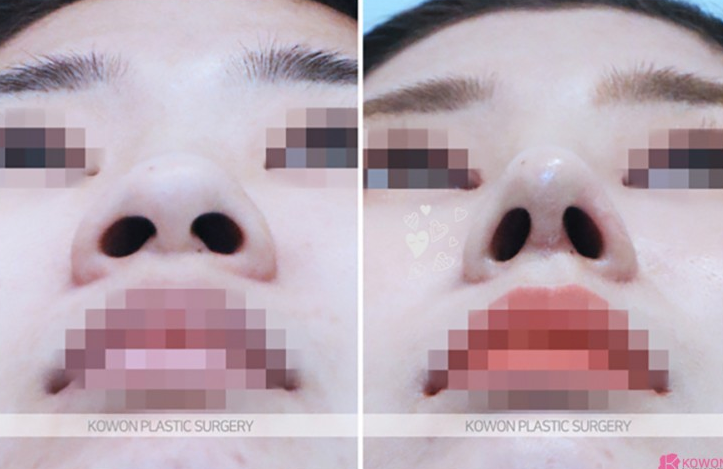 Q. 코수술 부작용일까요? 안경을 착용하면 통증이 느껴져요 관련 이미지 5