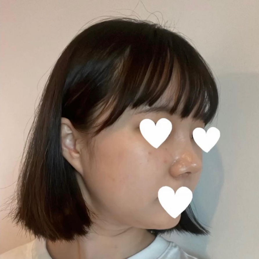 I Was Reborn with Small, Bulbous Nose Correction and Functional Nose Surgery for Deviated Septum at Kowon Plastic Surgery image 7