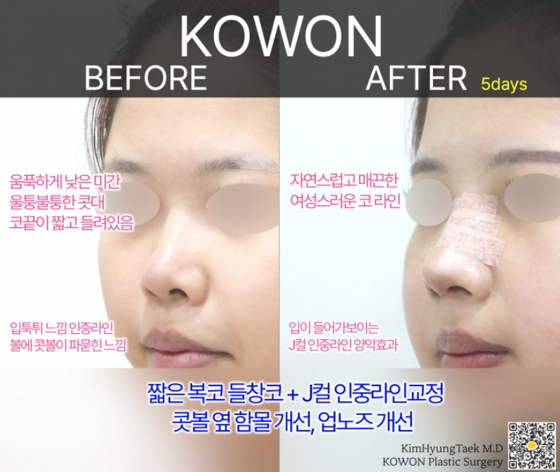 짧은코 성형 전후 얼마나 변할까? 짧은코 변화 과정과 회복까지 관련 이미지 8