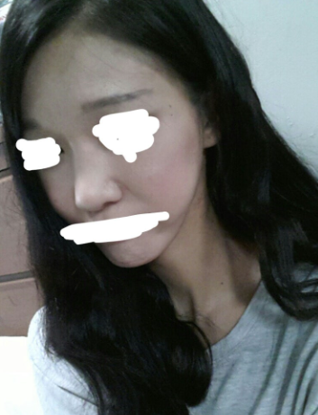 Q. 넓은 콧등뼈 절골술, 얼굴 더 길어 보일까요? 관련 이미지 4