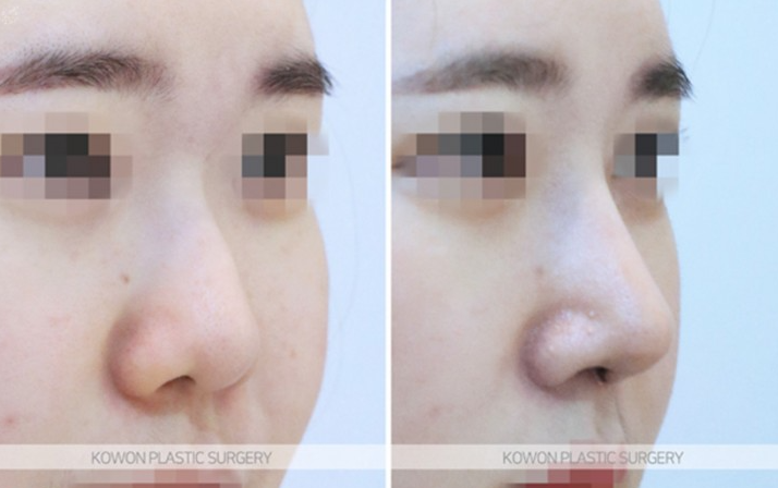 Q. Is Kangnam nose revision surgery necessary for a nose tip surgery complication? image 7