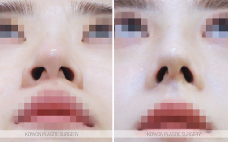 Q. I’m asking because I’m worried about complications after tip surgery and the duration of non-incisional alar reduction. image 8
