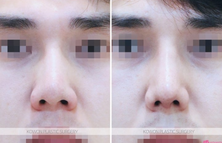 Q. When Is Revision Nose Surgery or Nose Reconstruction Surgery Needed, and Tips for Choosing a Well-Known Revision Nose Surgery Clinic image 10