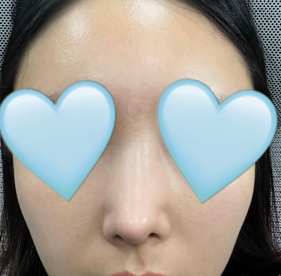 매부리코교정, 비염수술코성형까지 한번에 해결 됐어요! 관련 이미지 3