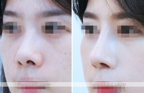 Q. Rhinoplasty precautions: After nose surgery, is it okay if my glasses press on my nose? image 4