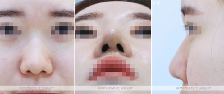 Q. Is Kangnam nose revision surgery necessary for a nose tip surgery complication? image 4