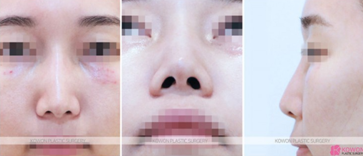 What Is Refined Natural Nose Surgery? Check This If You’re Considering Small Nose Surgery image 5