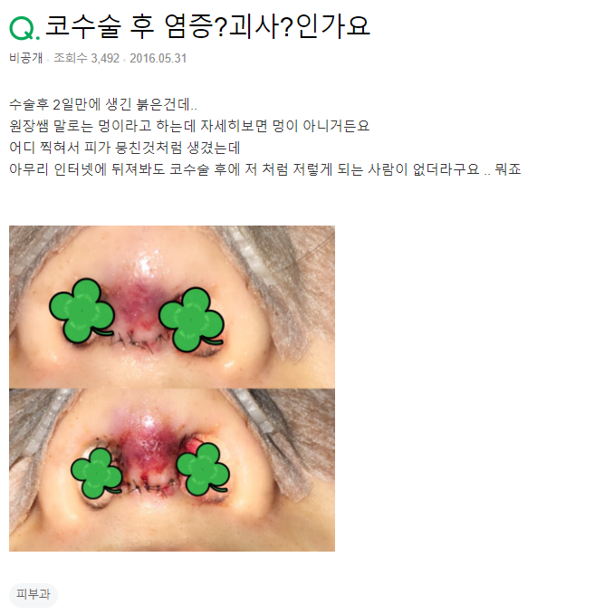 Q. 코성형괴사? 코성형염증?? 부작용인지 봐주세요.. 관련 이미지 2
