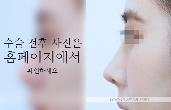 코끝연골재배치 자연스러운 자려한 코를 만드는 3가지 포인트 관련 이미지 6