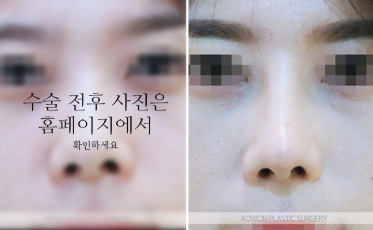 낮은코성형 코끝부터 비순각까지 함께 봐야 하는 3가지 이유 관련 이미지 9
