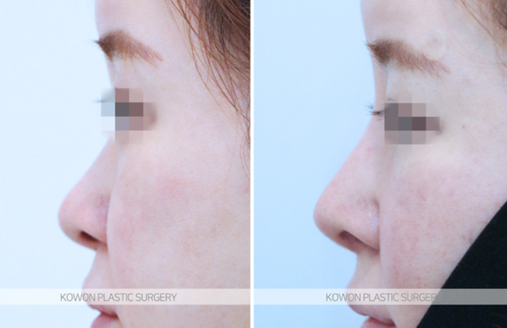 Q. I heard that 10 years after nose surgery, revision surgery is mandatory. Is that true? image 7