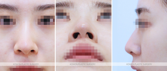 코끝연골재배치 자연스러운 자려한 코를 만드는 3가지 포인트 관련 이미지 4